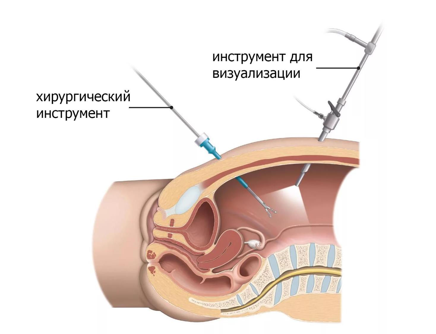 Лапароскопия удаление. Операция лапароскопия. Диагностическая лапароскопия брюшной полости. Лапароскопия аденомы простаты.