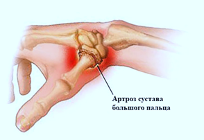 Лечение заболеваний и воспалений суставов пальцев на руках