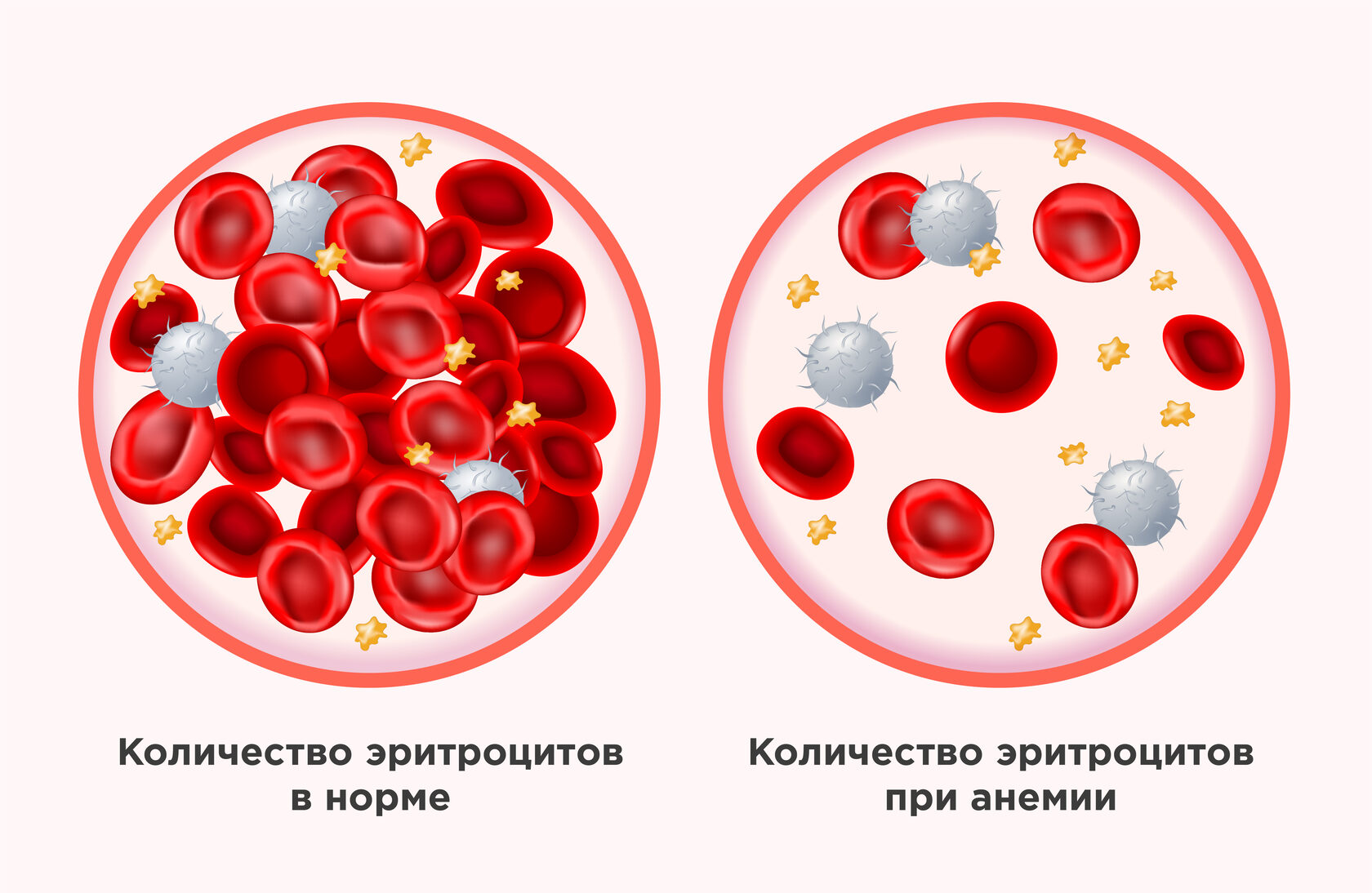 Геморроидальная анемия 