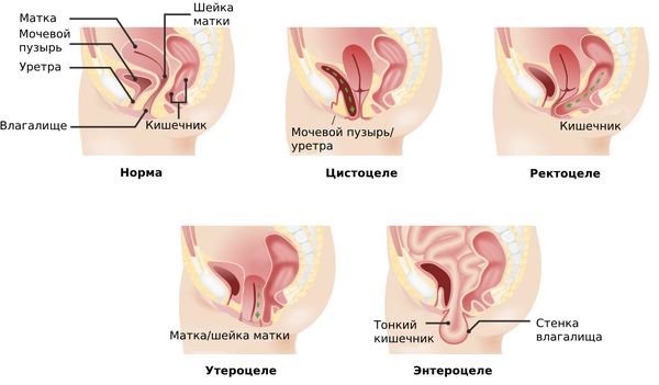 Операция при опущении матки, стенок влагалища | Клиника диагностики и лечения на Измайлова